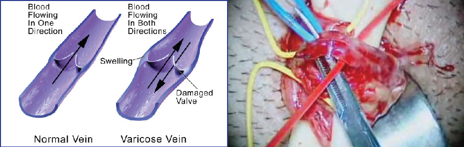 Micro varicocelectomy and Varicocele Embolization