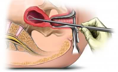 endometrial biopsy