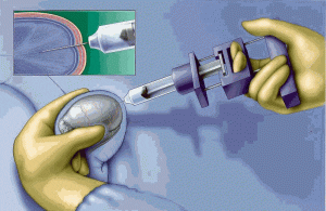 epididymal aspiration of sperm