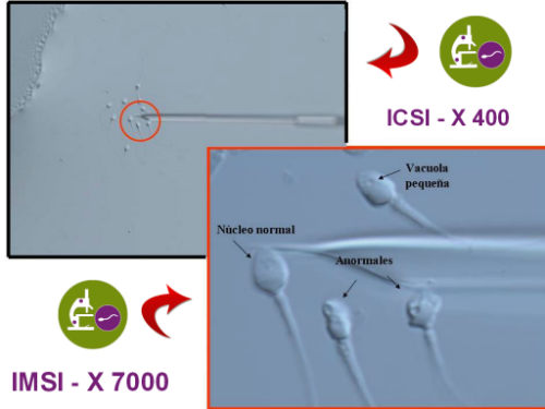 sperm injection home kit