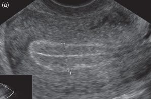 Triple Layer Endometrium