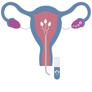 IUI Procedure