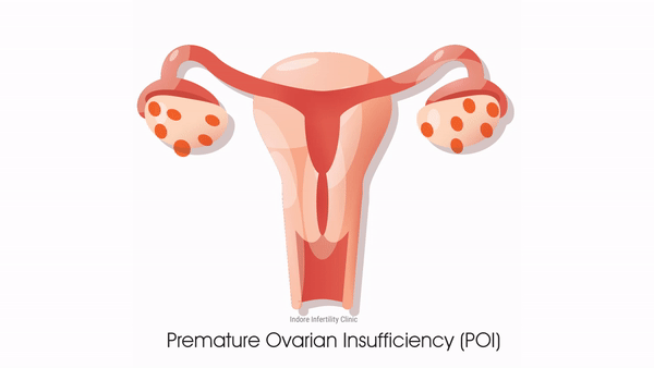 premature ovarian failure treatment