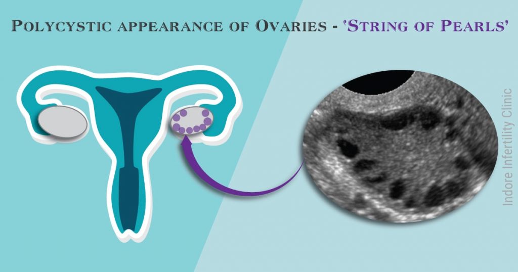 PCOS And Your Infertility Treatment Indore Infertility Clinic pcos-and-your-infertility-treatment-indore-infertility-clinic