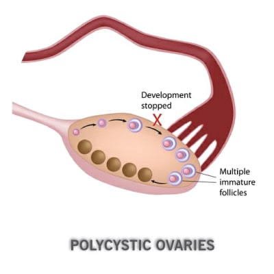 polycystic-ovaries