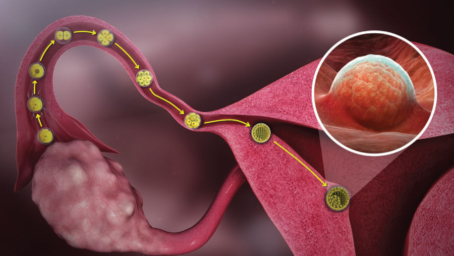 Blockage or narrowing of Fallopian tube