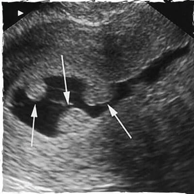 MultipleUterinePolyps