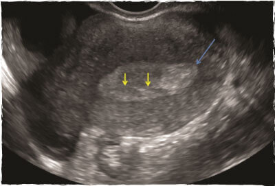 Uterine Polyp on Ultrasound