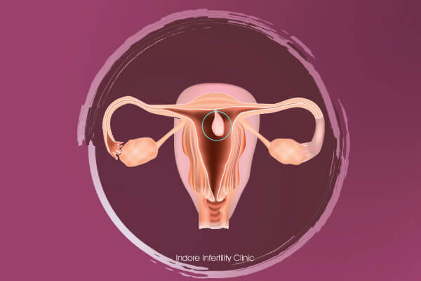 Uterine / Endometrial Polyp Removal