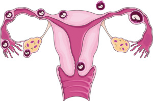 Sites of Ectopic Pregnancy