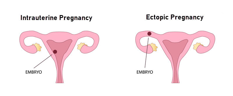 Getting Pregnant after Ectopic Pregnancy