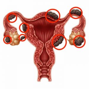 endometriosis diagnosis