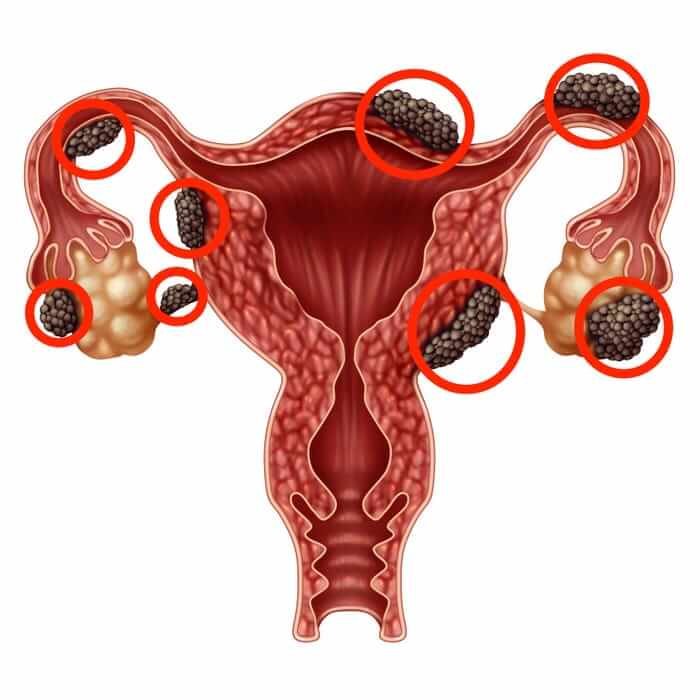 endometriosis diagnosis