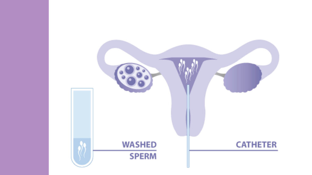 IUIInseminationBestIndore