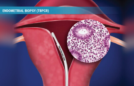 EndometrialBiopsyTB-PCRIndoreCost