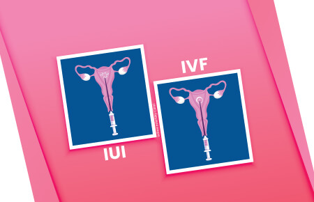 Difference between IUI and IVF