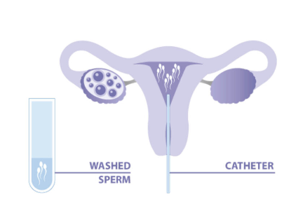 iui intrauterine insemination