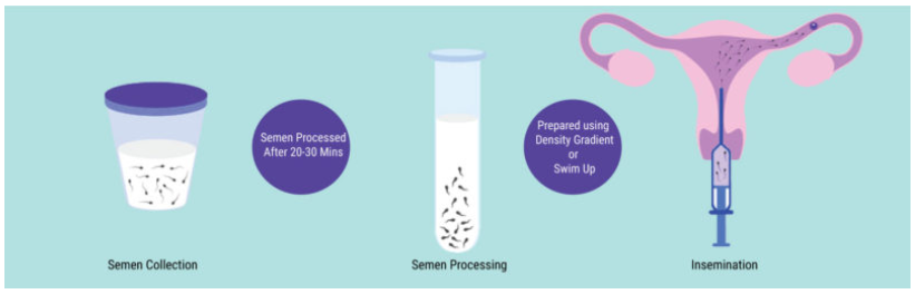 iui process