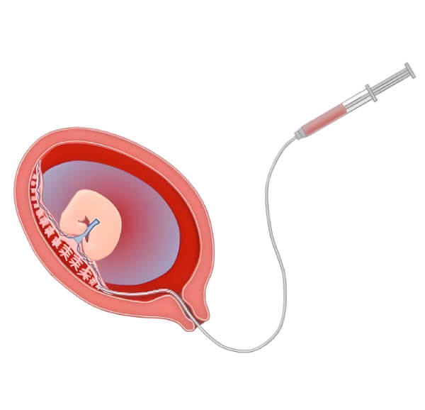 chorionic villus sampling