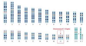Trisomy21