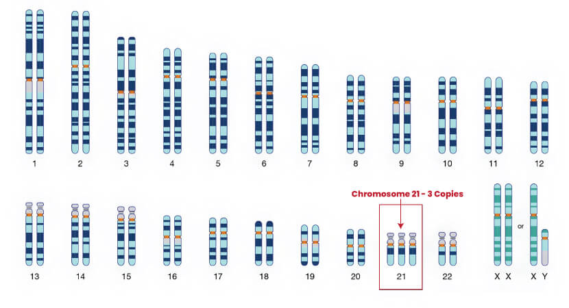 Trisomy21