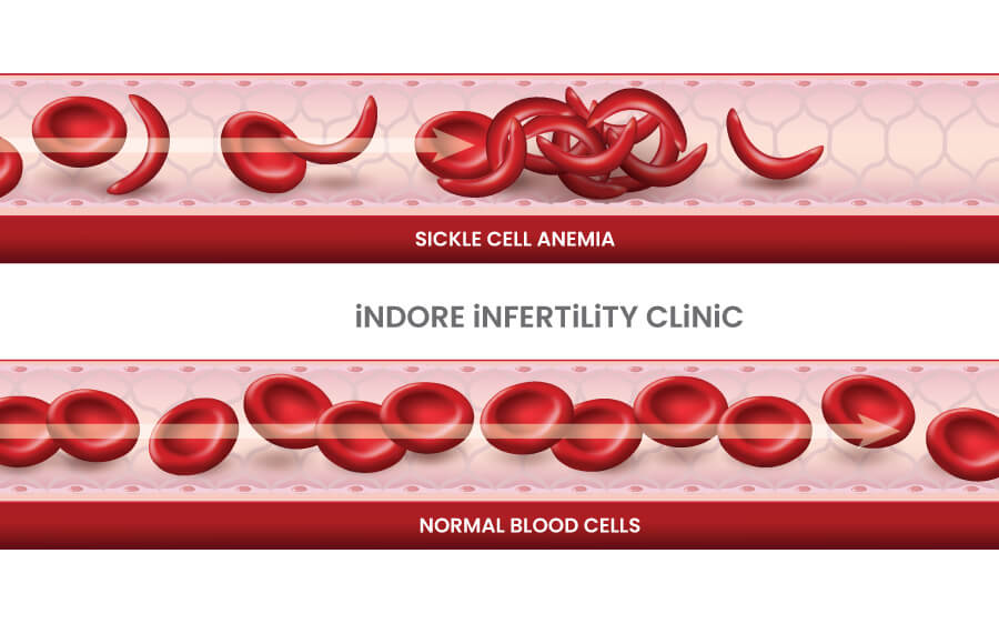 Normal Blood Cell vs Sickle Cell