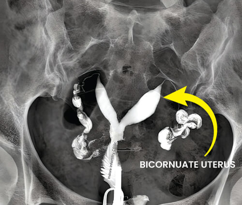 Bicornuate Uterus