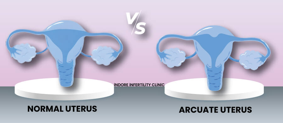 Arcuate Uterus vs Normal Uterus