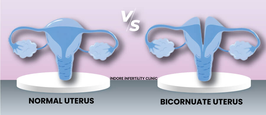 Normal vs Bicornuate Uterus