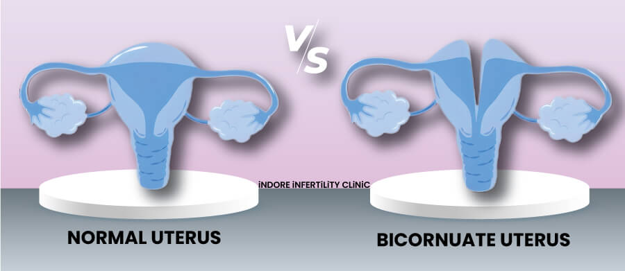 Bicornuate Uterus Treatment Bicornuate Uterus SpringerLink Bicornuate Uterus Treatment Bicornuate Uterus SpringerLink