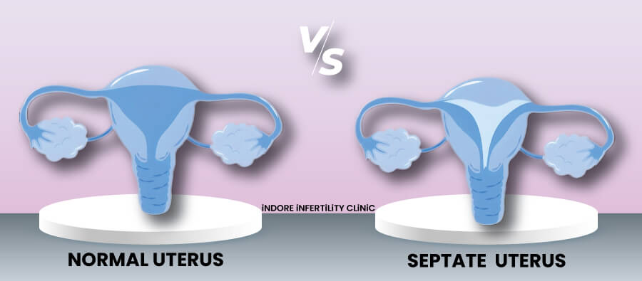 Normal vs Septate Uterus