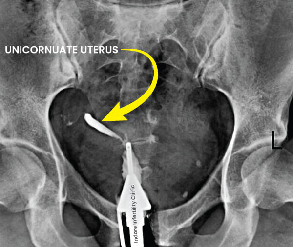 Unicornuate Uterus