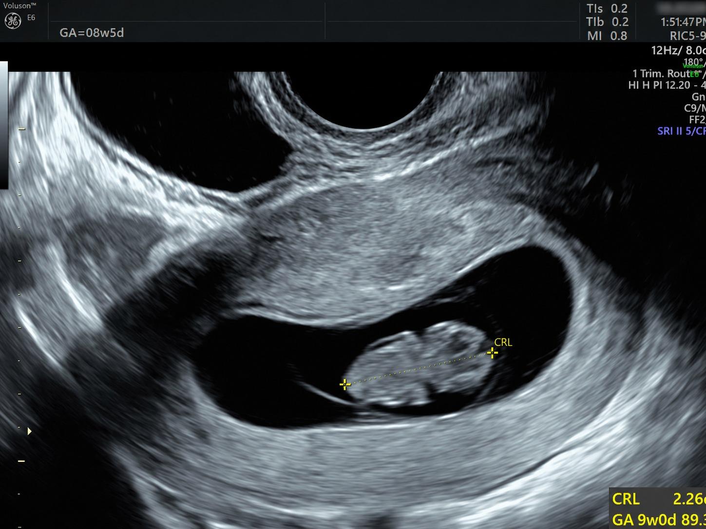 The Embryo That Waited